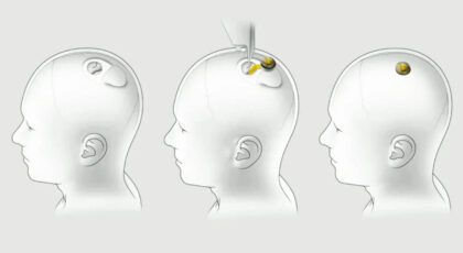Neuralink ایلان ماسک پروژه جنجالی چیپ مغزی را شروع می کند!